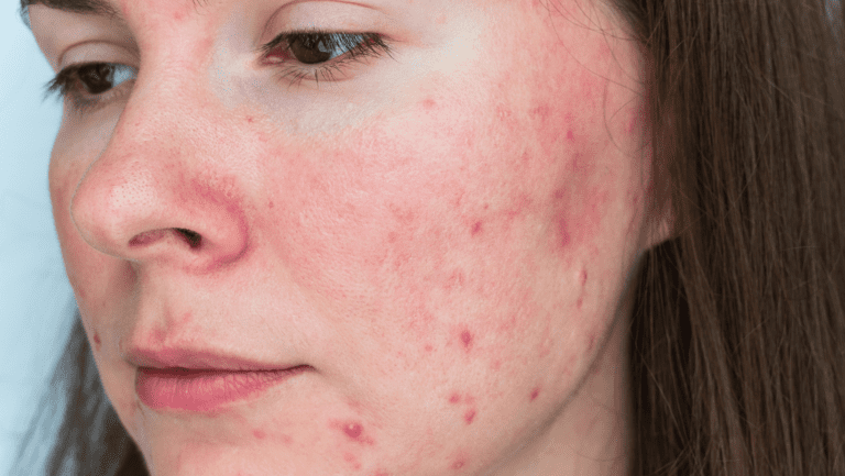 rosacea condition treatment private online doctor Gorleston