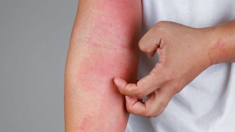 eczema skin condition treatment private dermatology clinic, Gorleston