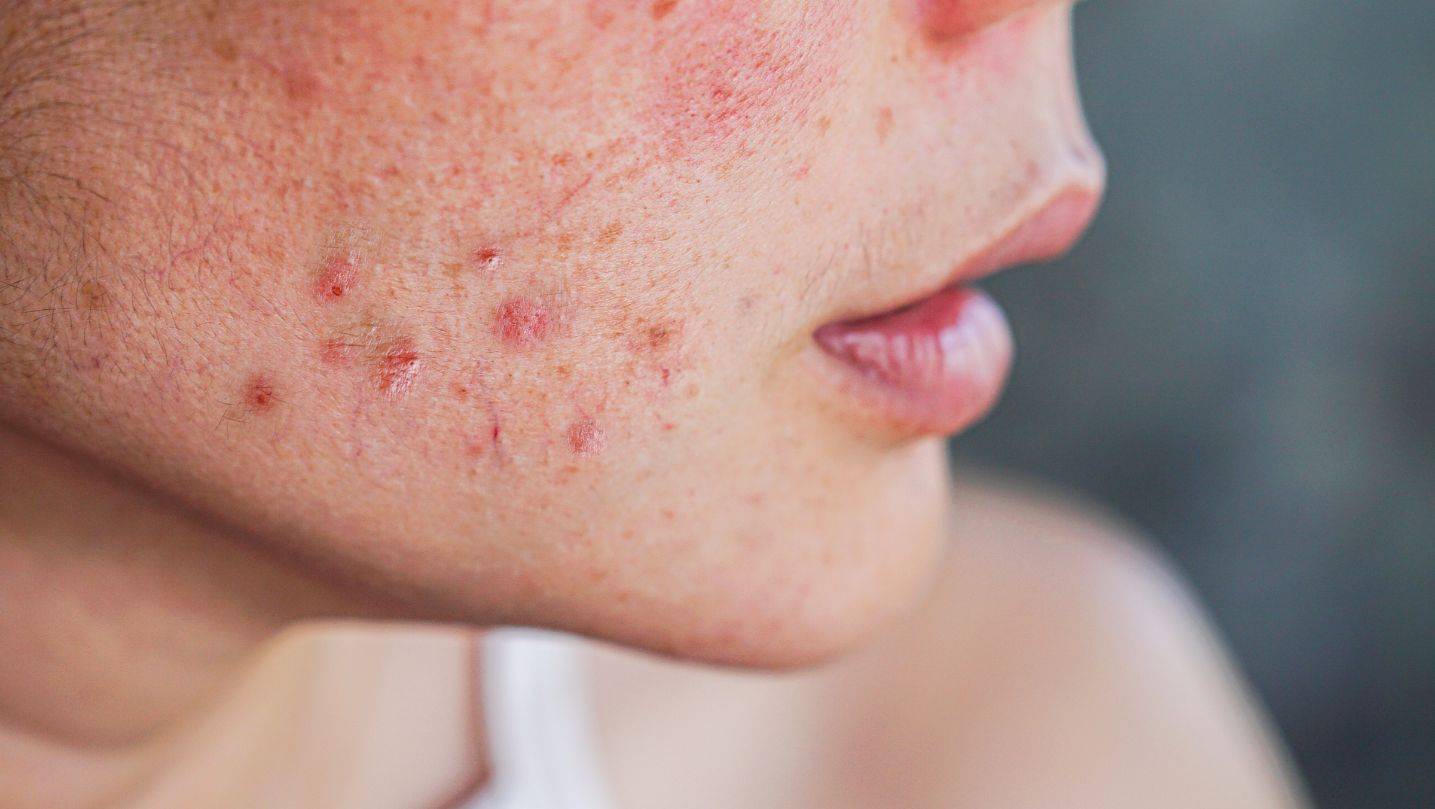 Acne treatment online Gorleston