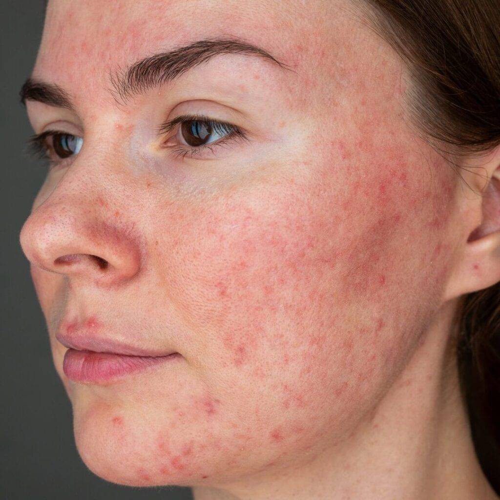 Buy rosacea treatment online