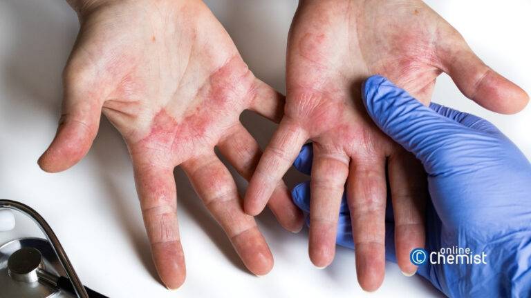 contact dermatitis treatment