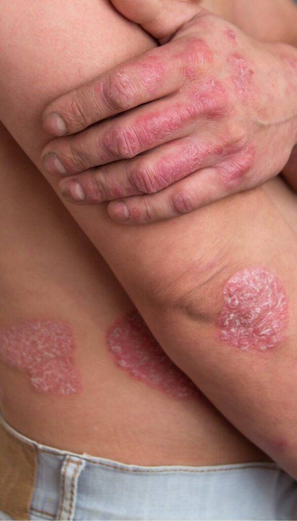 Psoriasis treatment online from Online Chemist Gorleston, Great Yarmouth UK