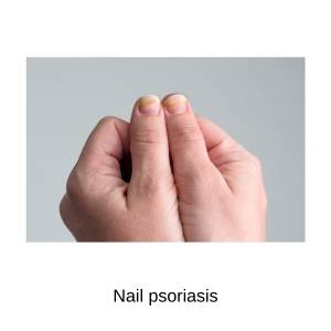 nail psoriasis treatment online