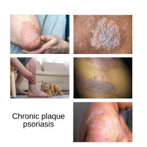 online chronic plaque psoriasis treatment