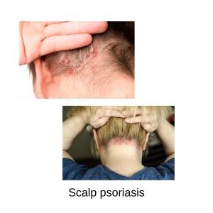 scalp psoriasis treatment online